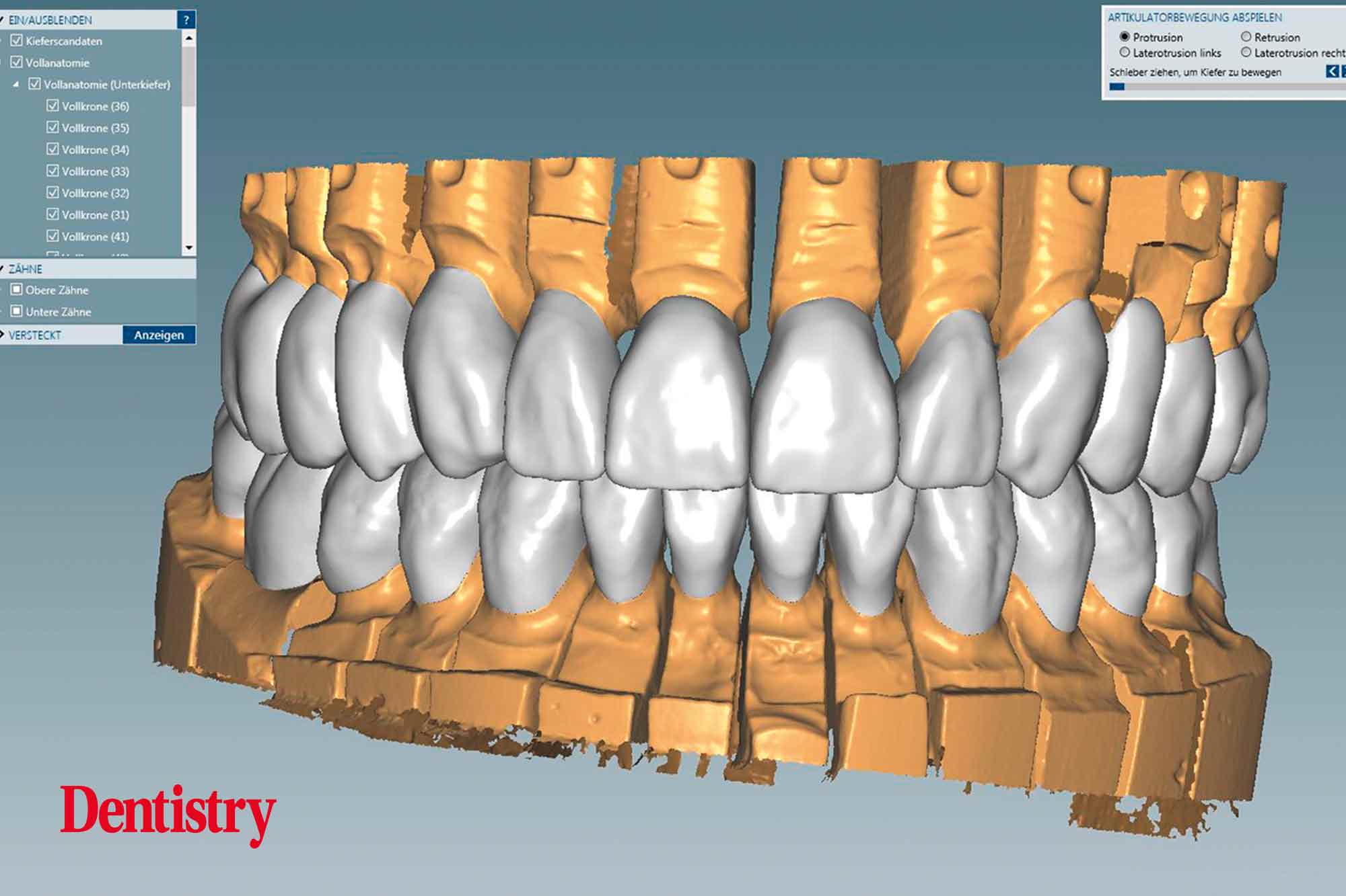 9 Fabrication and cementation of crowns without chipping