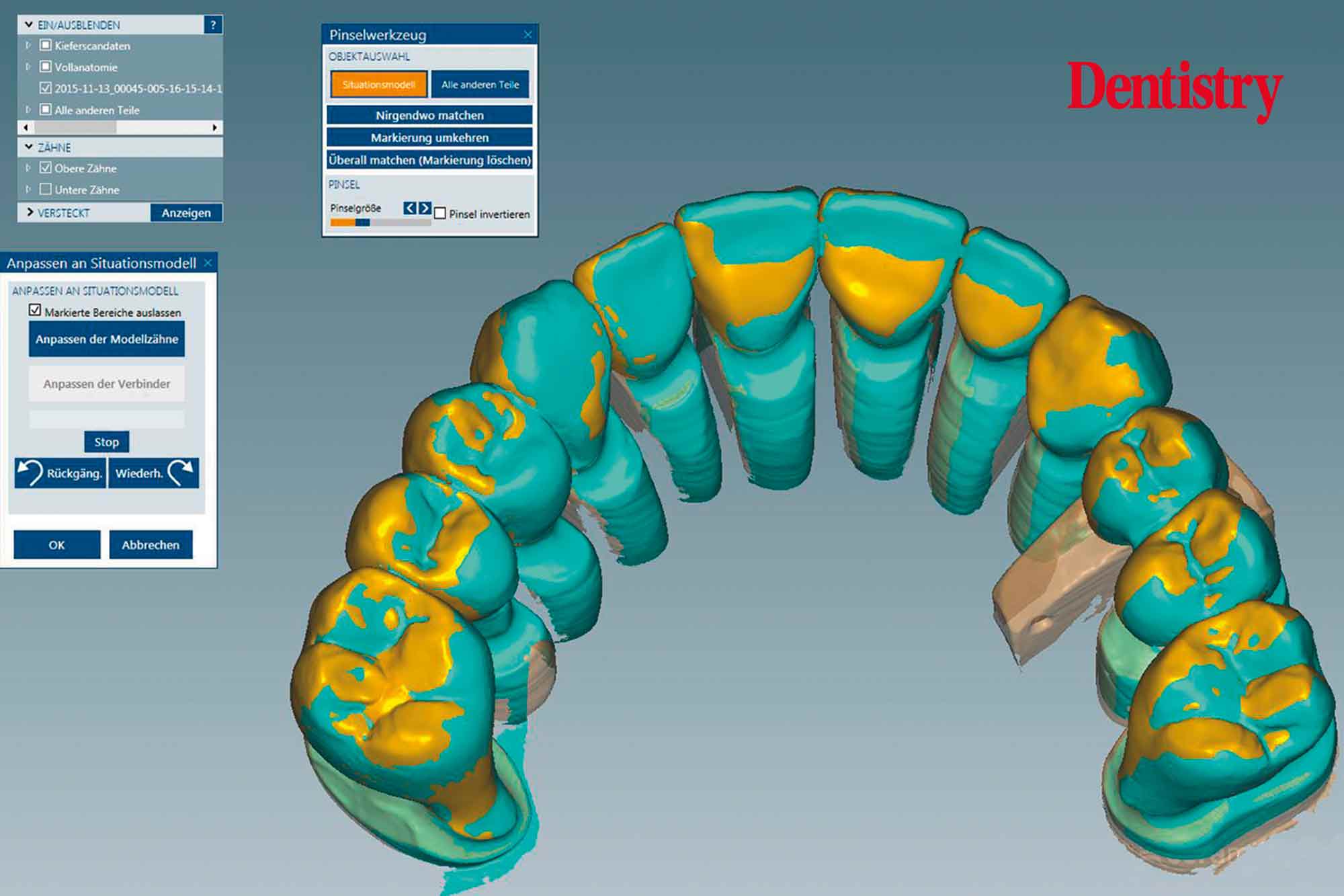 figure-13 Fabrication and cementation of crowns without chipping