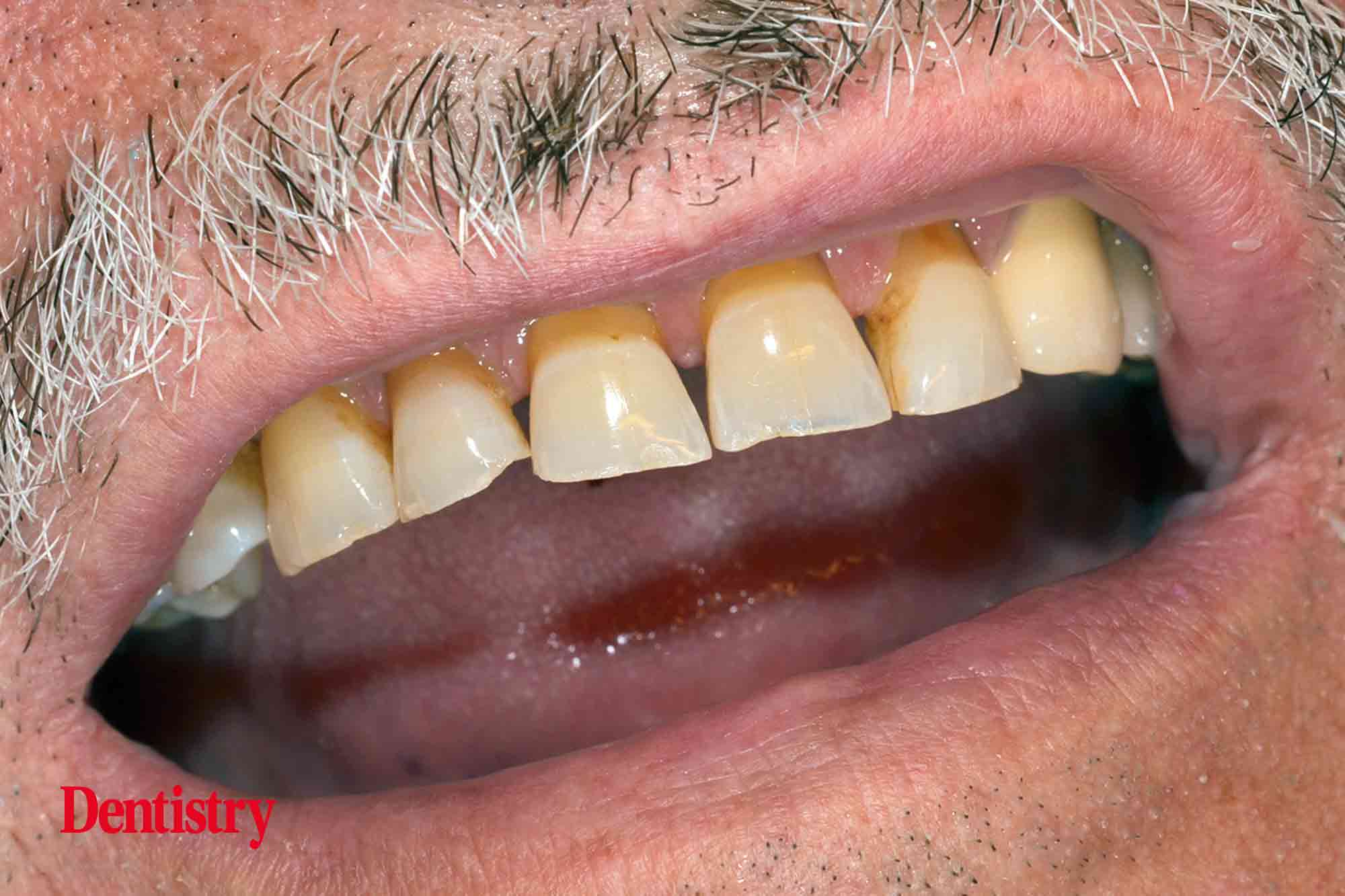 1b Fabrication and cementation of crowns without chipping