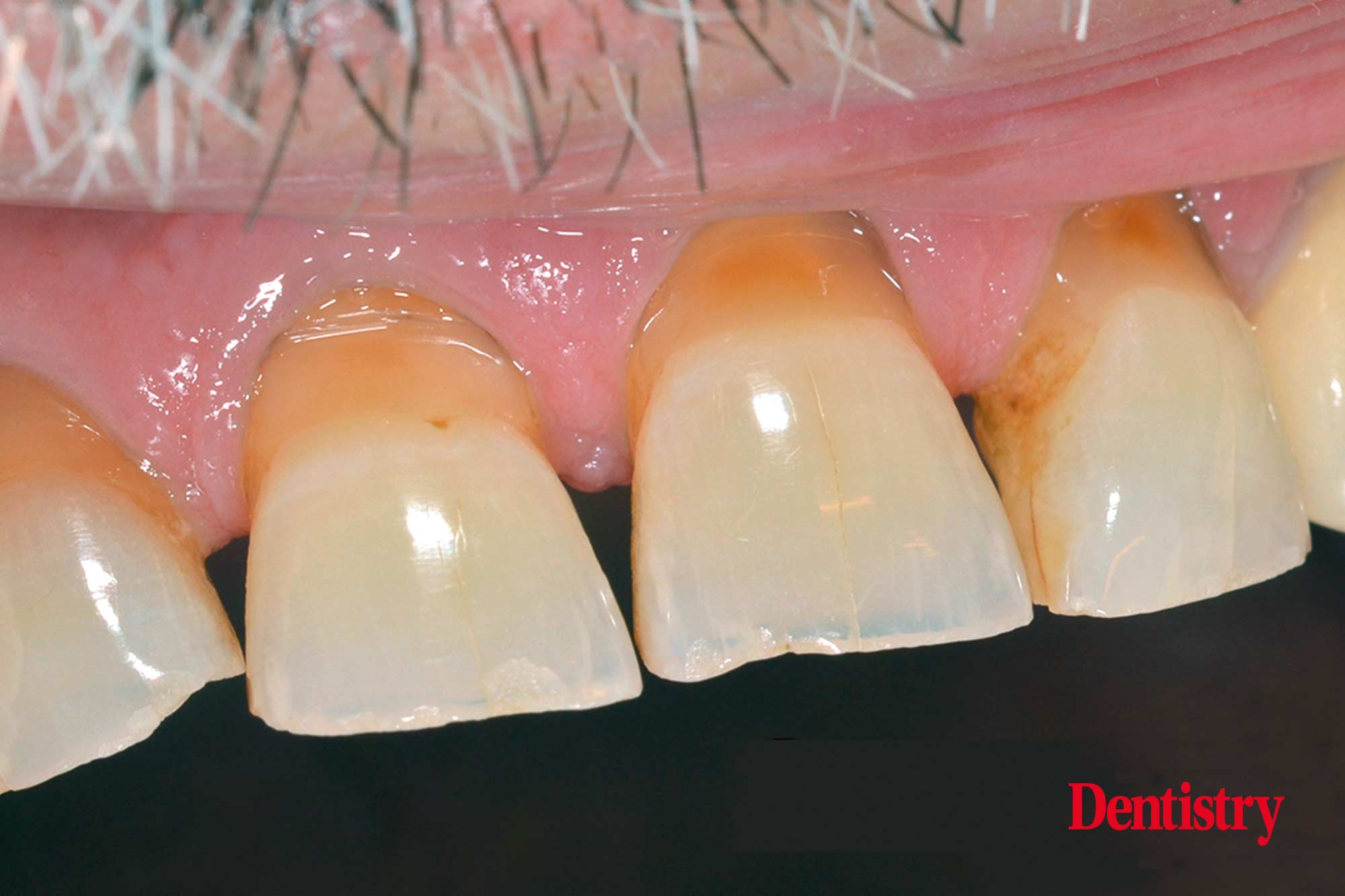 1c Fabrication and cementation of crowns without chipping