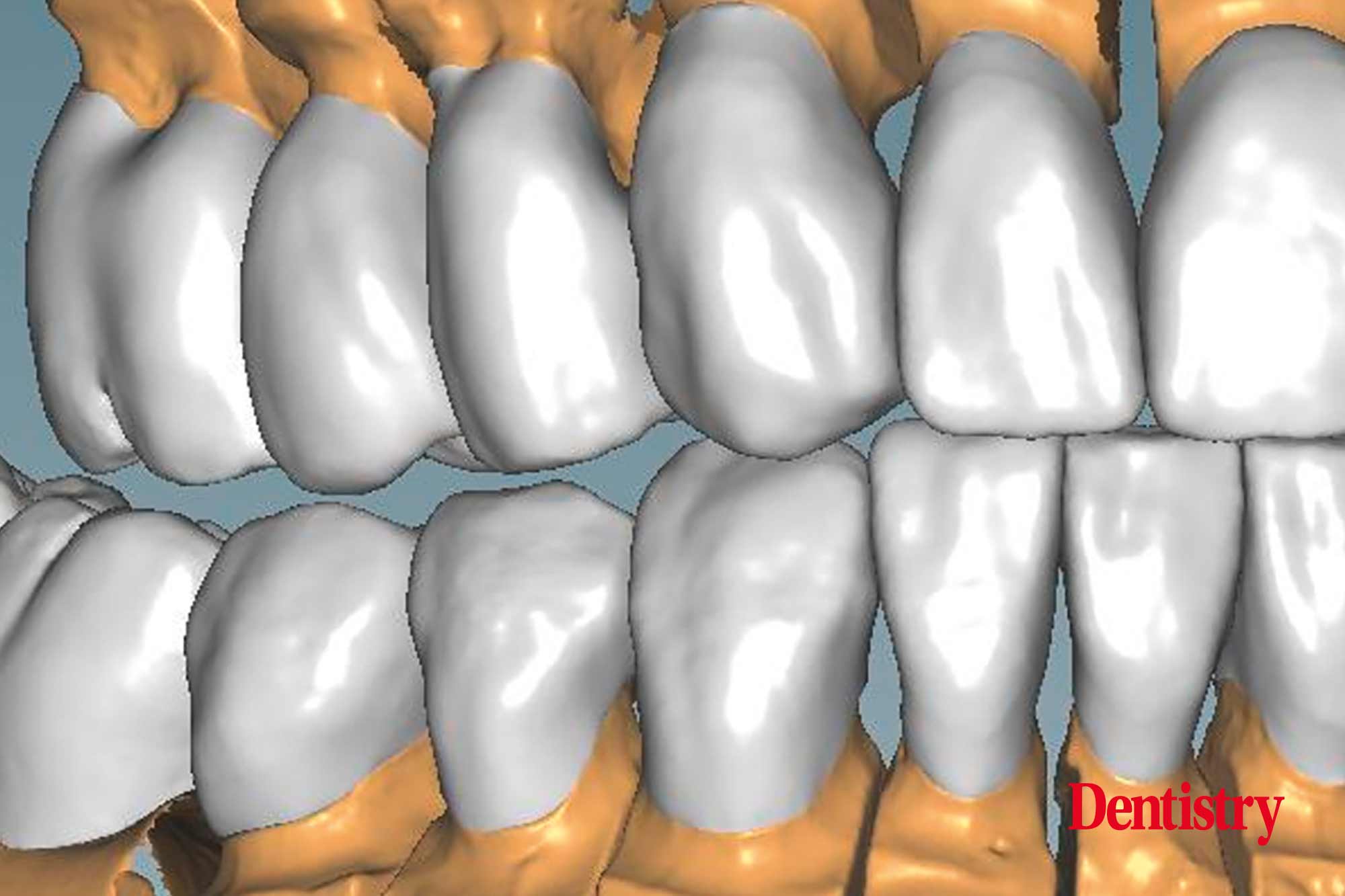 figure-23-a Fabrication and cementation of crowns without chipping