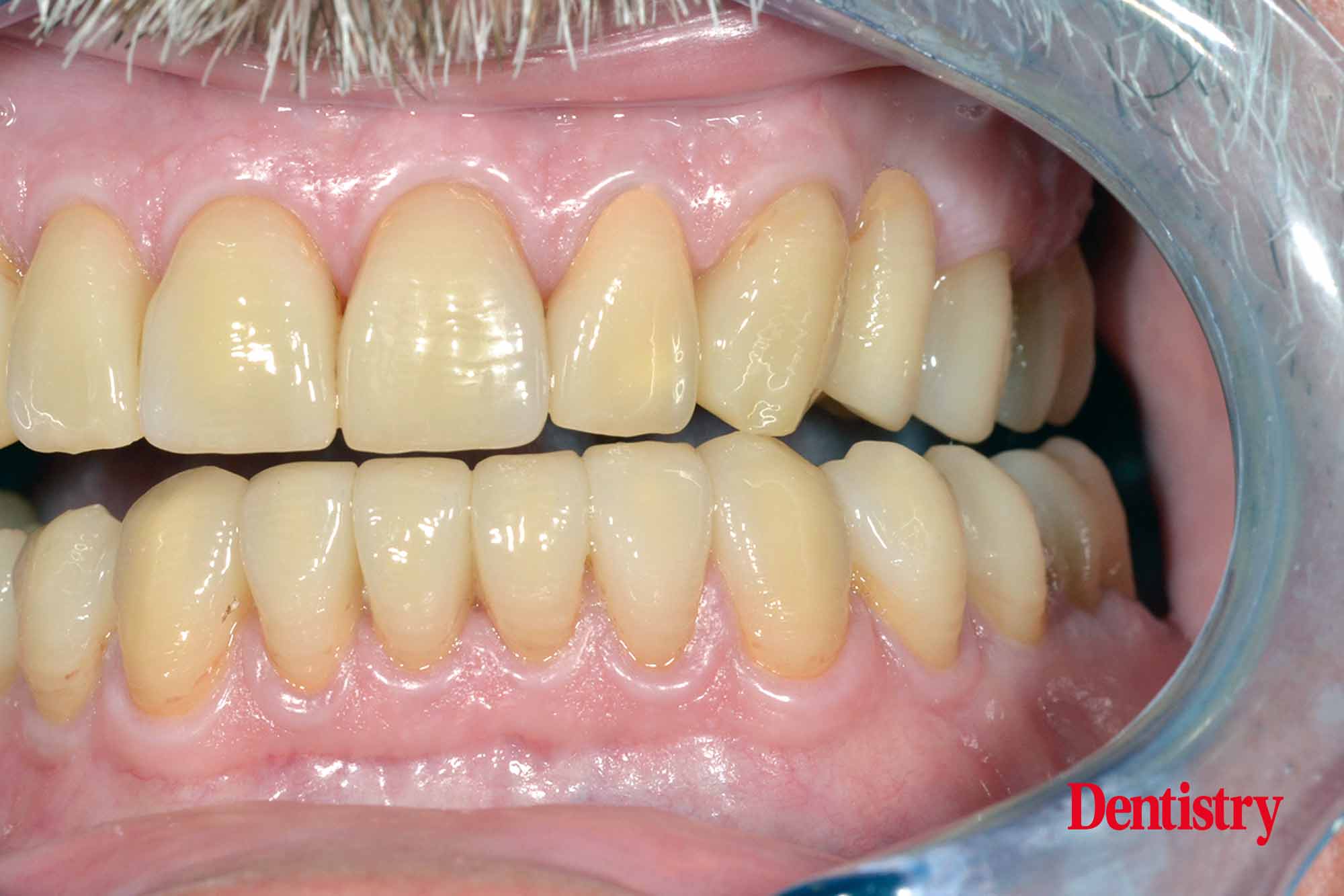 figure-24 Fabrication and cementation of crowns without chipping