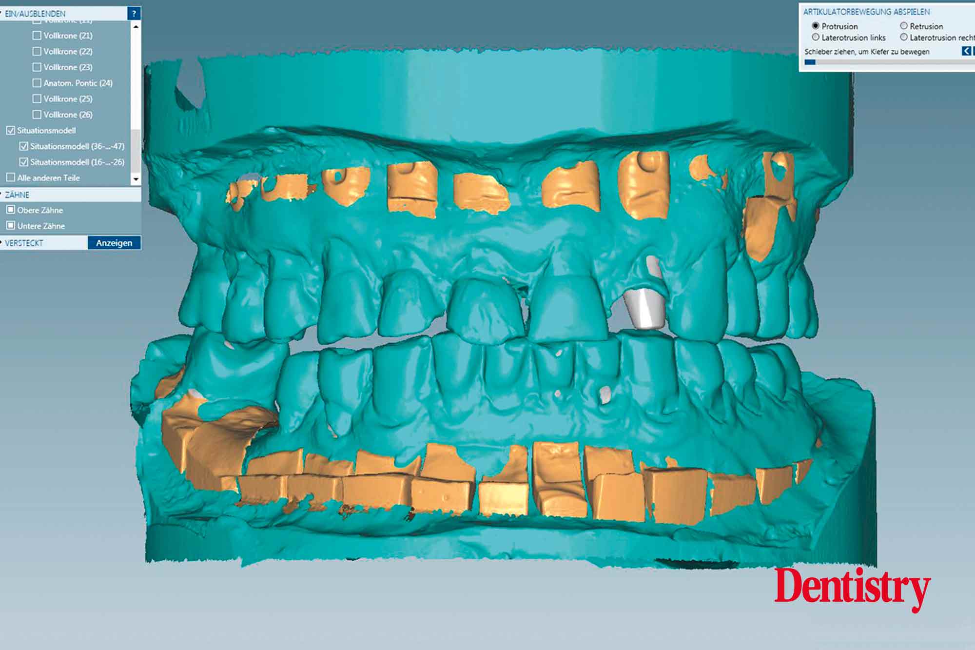 figure-3a Fabrication and cementation of crowns without chipping