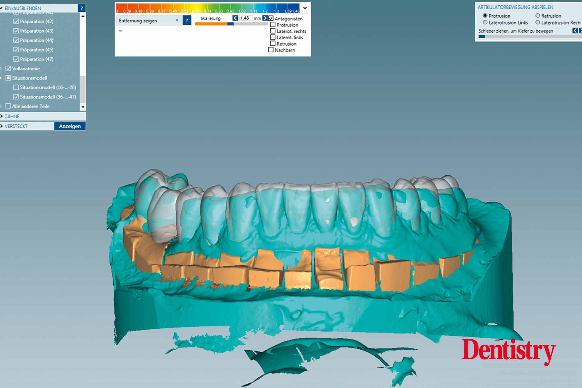 3c Fabrication and cementation of crowns without chipping