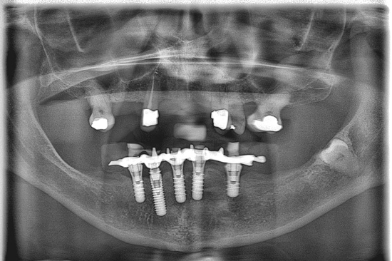 OPG of modest remosdelling