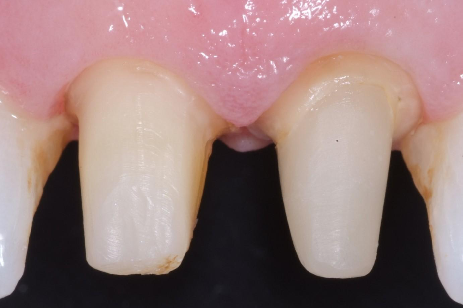 direct post core UL1