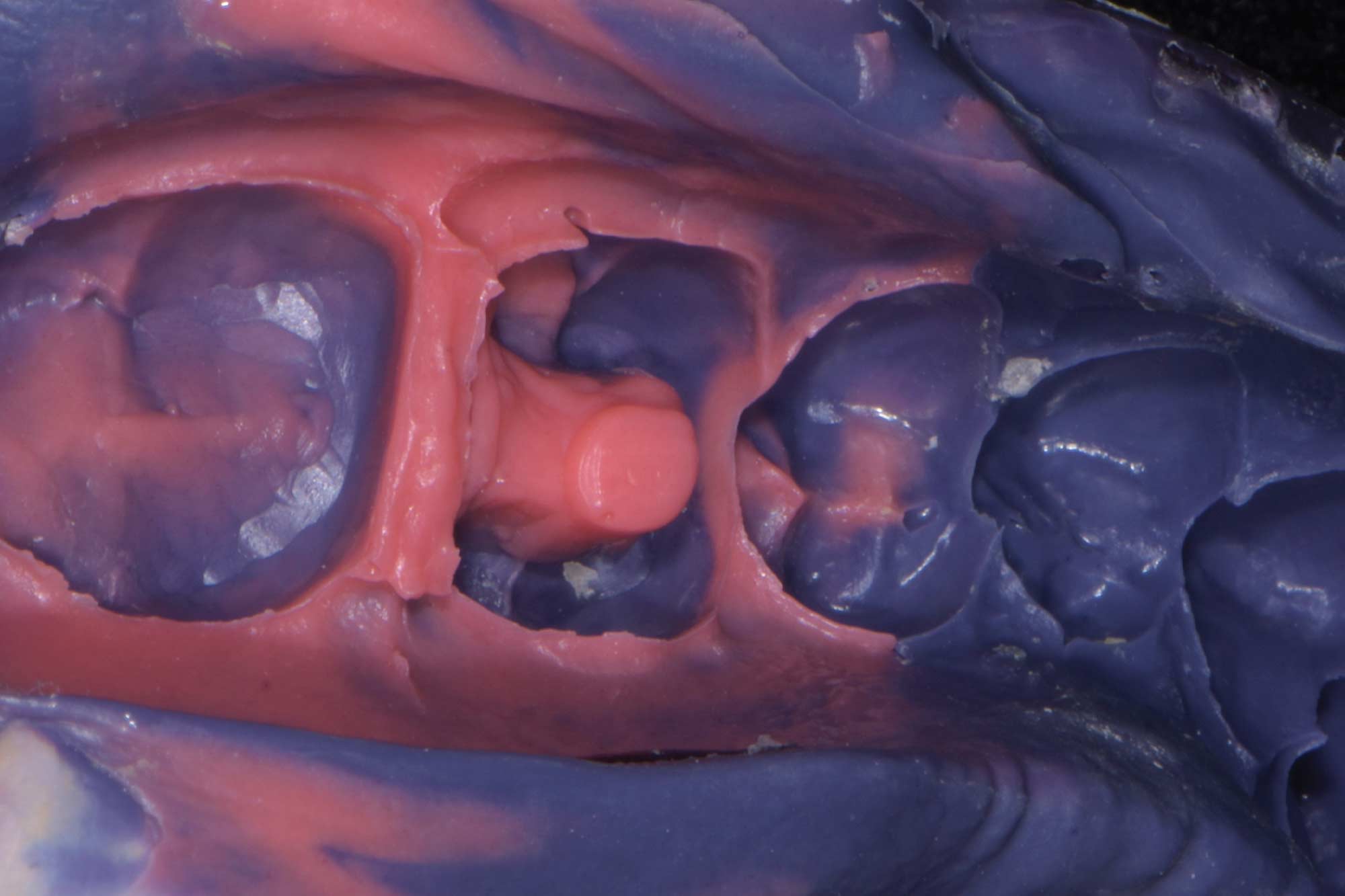 figure-1 Alan Cantagalli presents an onlay restoration case using natural-looking onlays, digital scanning and CAD design.