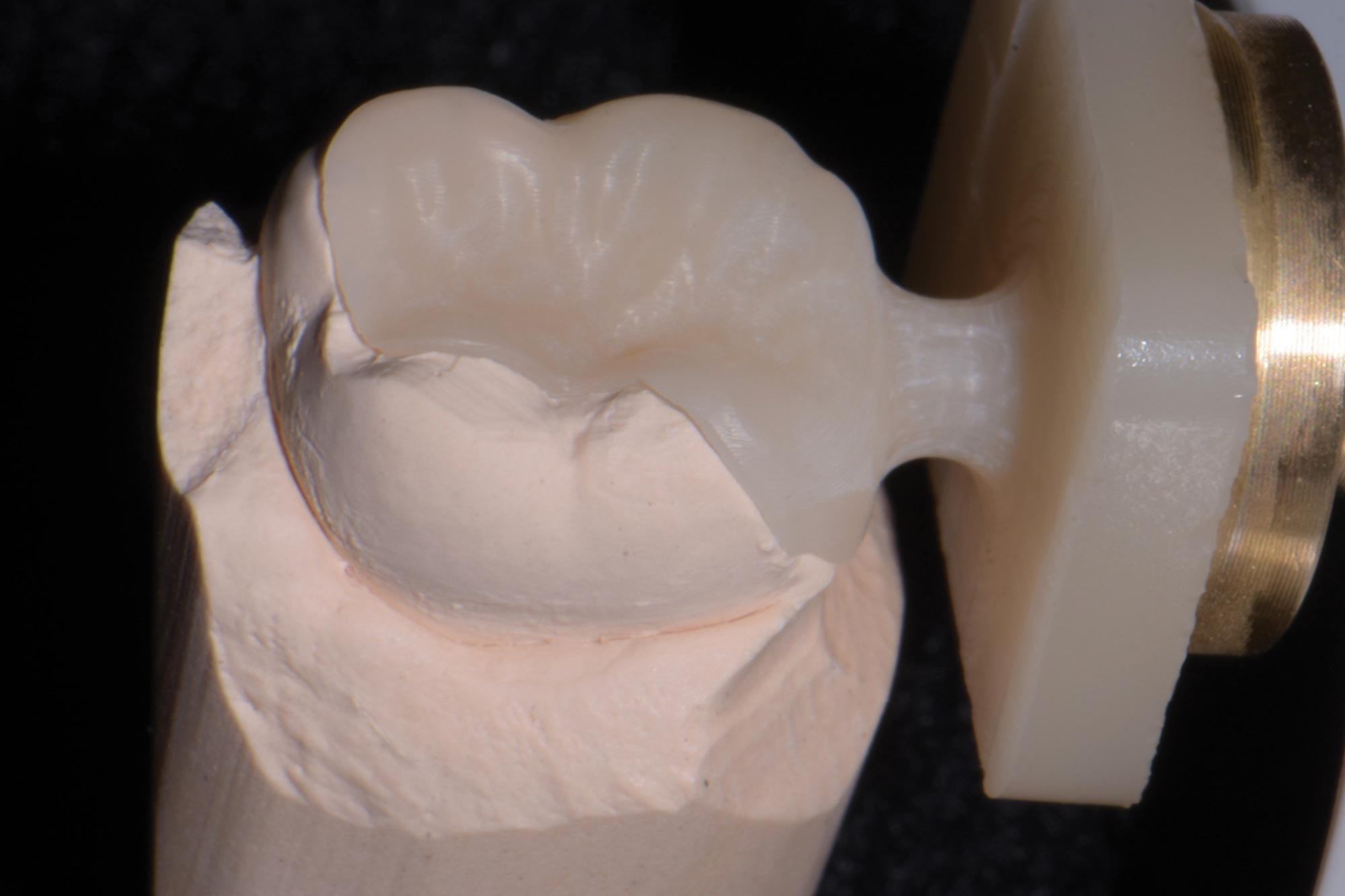 figure-11 Alan Cantagalli presents an onlay restoration case using natural-looking onlays, digital scanning and CAD design.