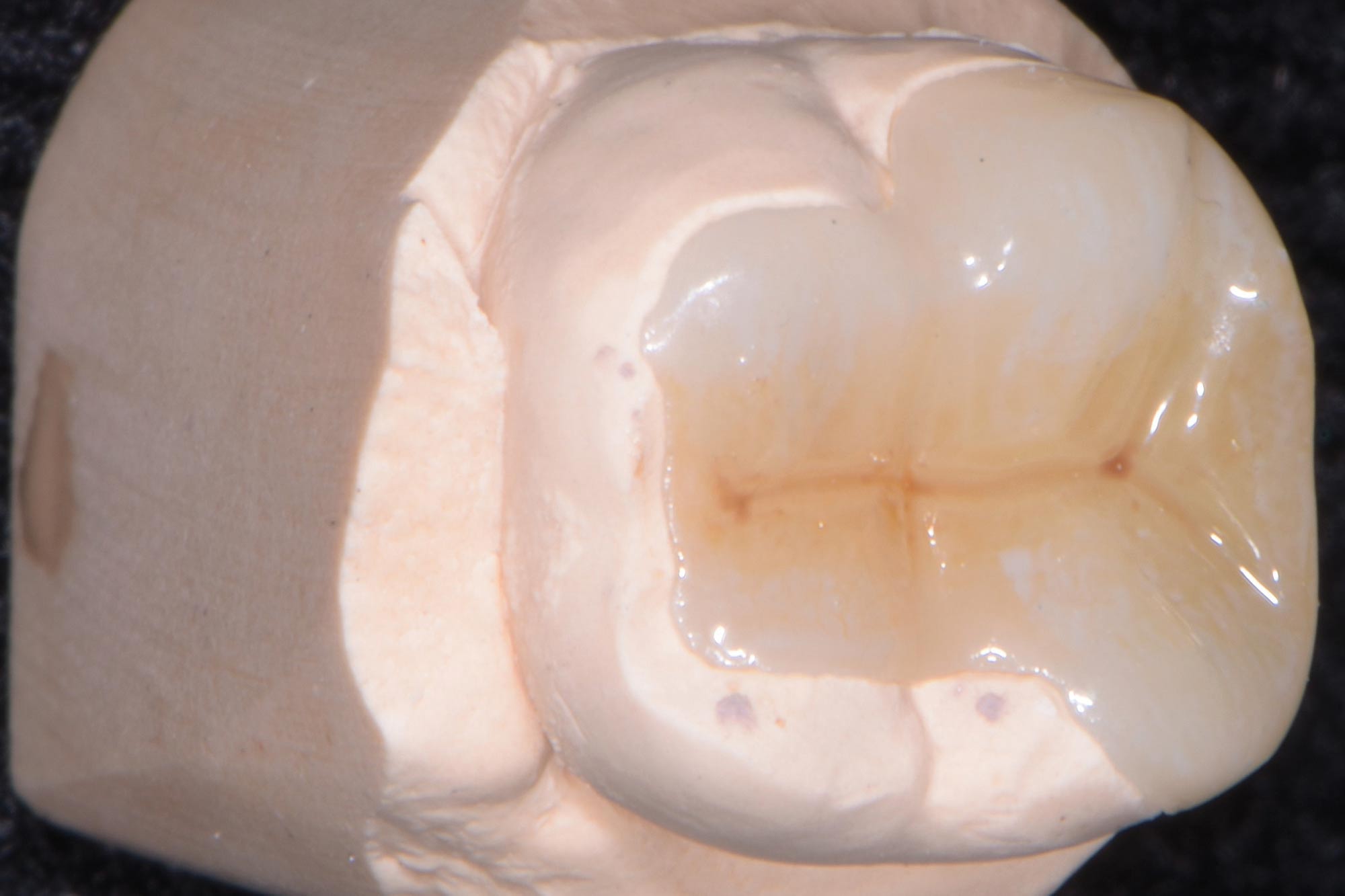 figure-14 Alan Cantagalli presents an onlay restoration case using natural-looking onlays, digital scanning and CAD design.