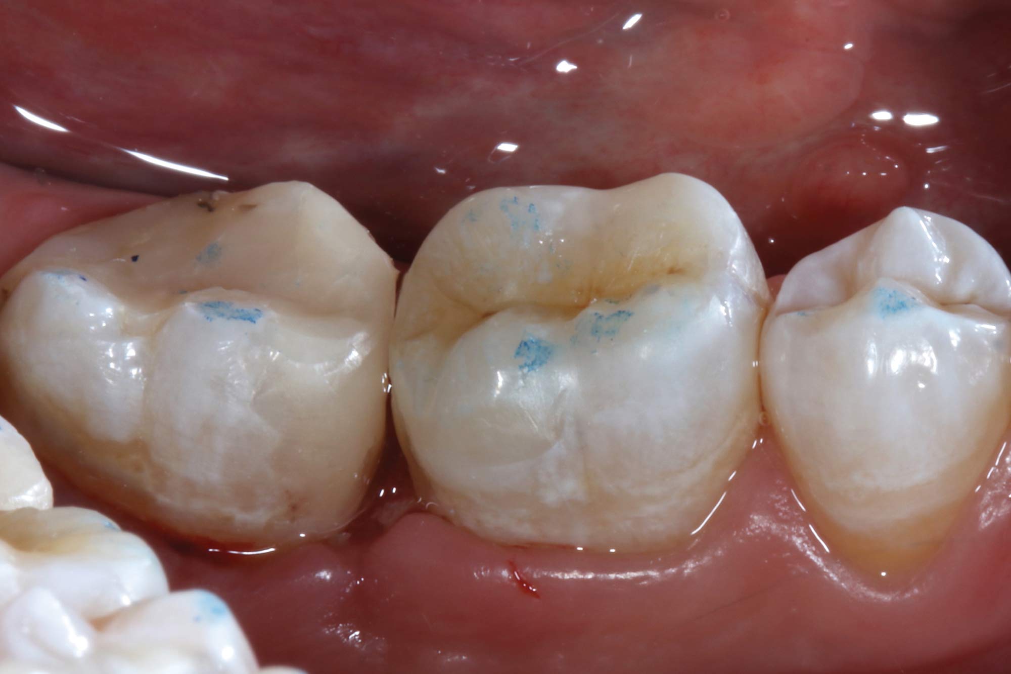 figure-17 Alan Cantagalli presents an onlay restoration case using natural-looking onlays, digital scanning and CAD design.