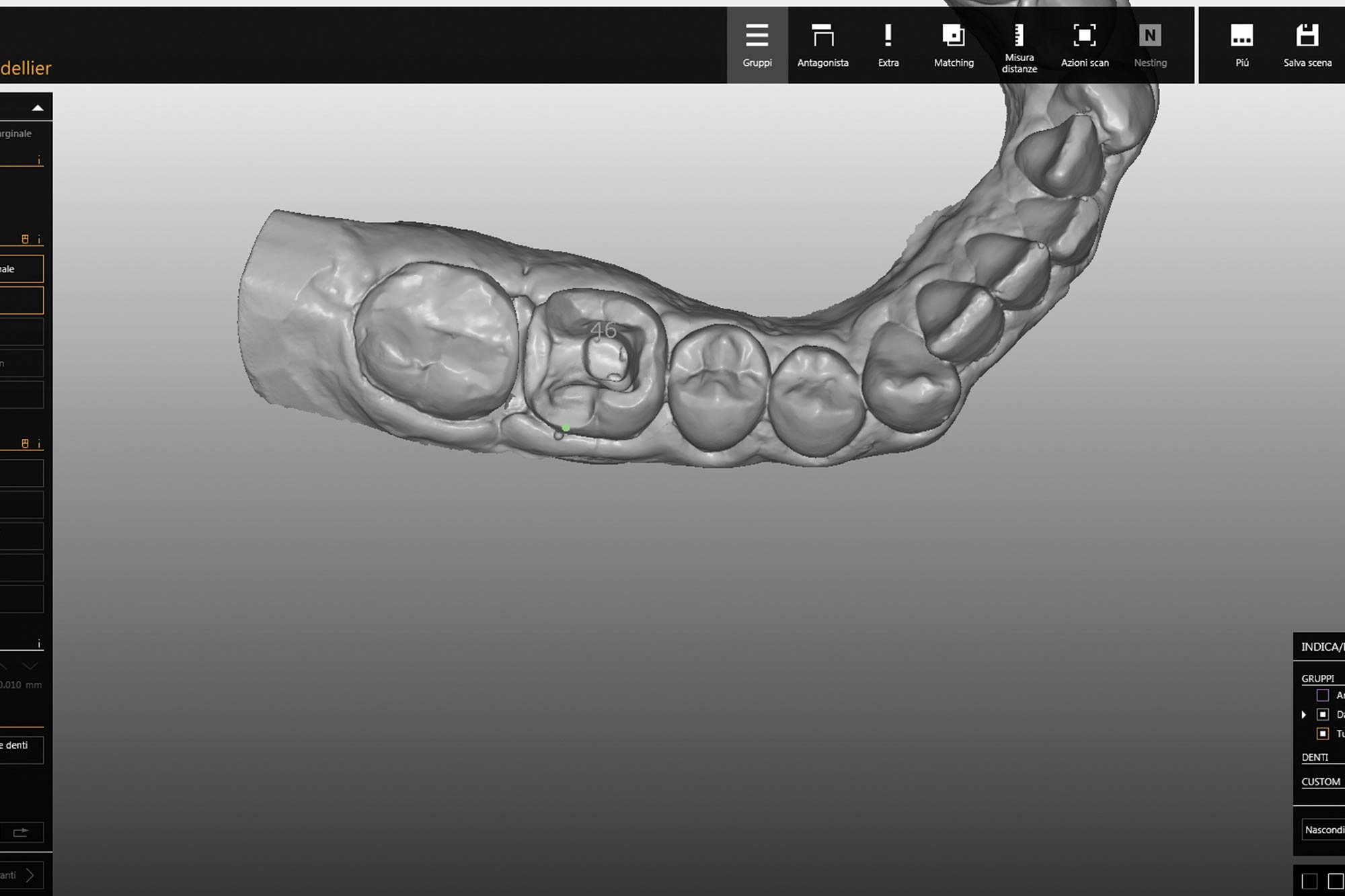 figure-5 Alan Cantagalli presents an onlay restoration case using natural-looking onlays, digital scanning and CAD design.