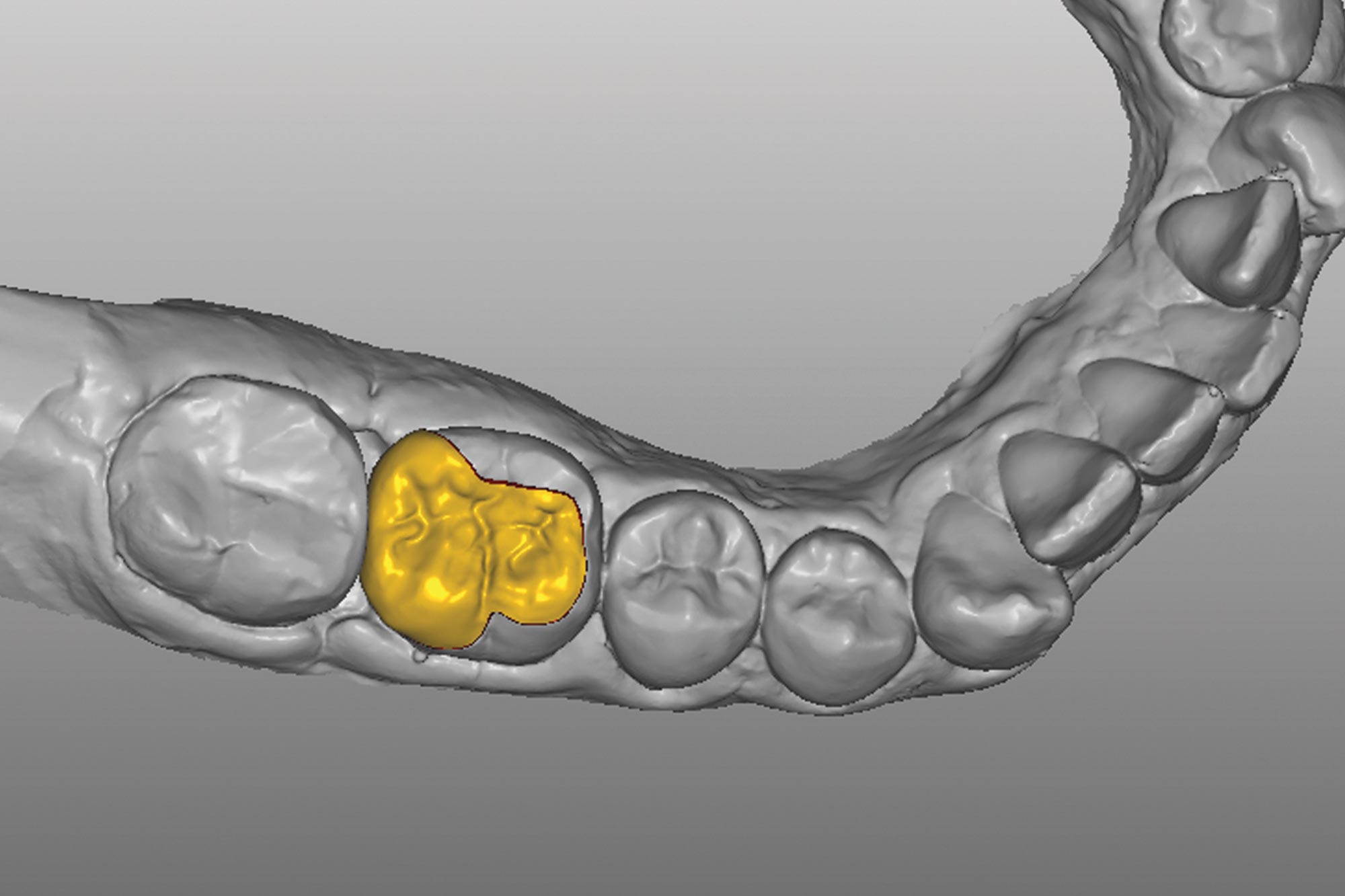 figure-8 Alan Cantagalli presents an onlay restoration case using natural-looking onlays, digital scanning and CAD design.