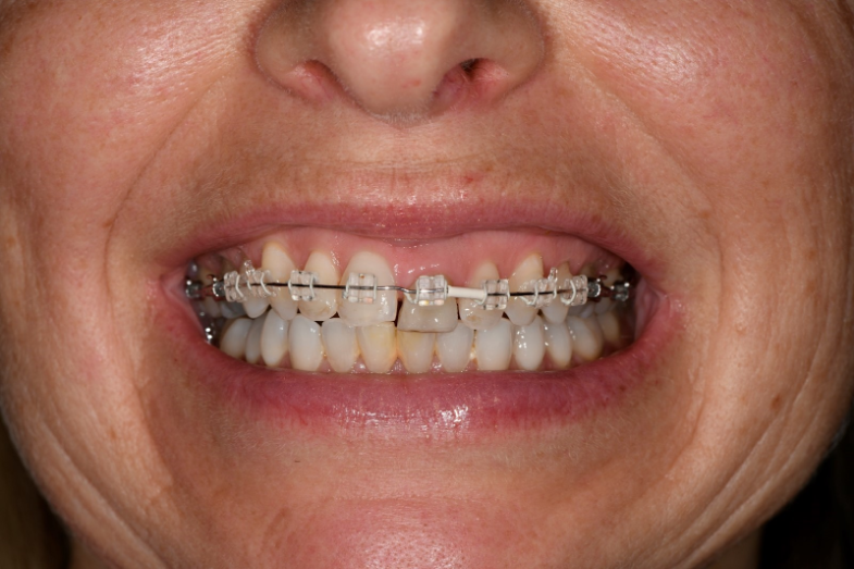 forced eruption Forced eruption of the hopeless UL1