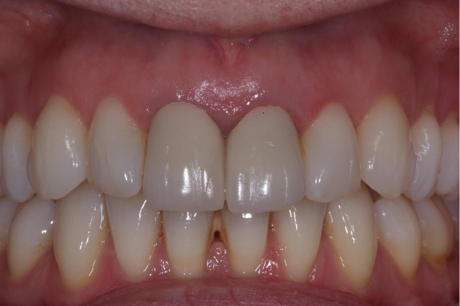 fractured porcelain jacket