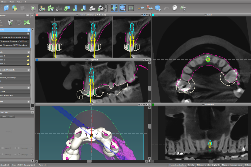 precise virtual planning Precise virtual planning and surgical guide design using Codiagnostix
