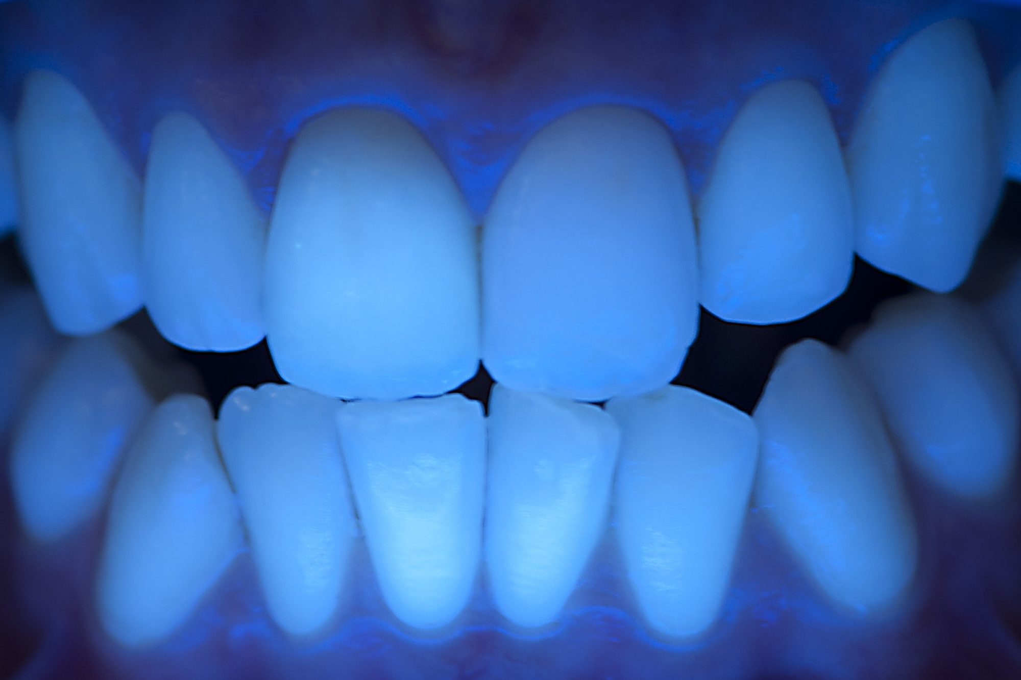 Ceramic Crown_023 Figure