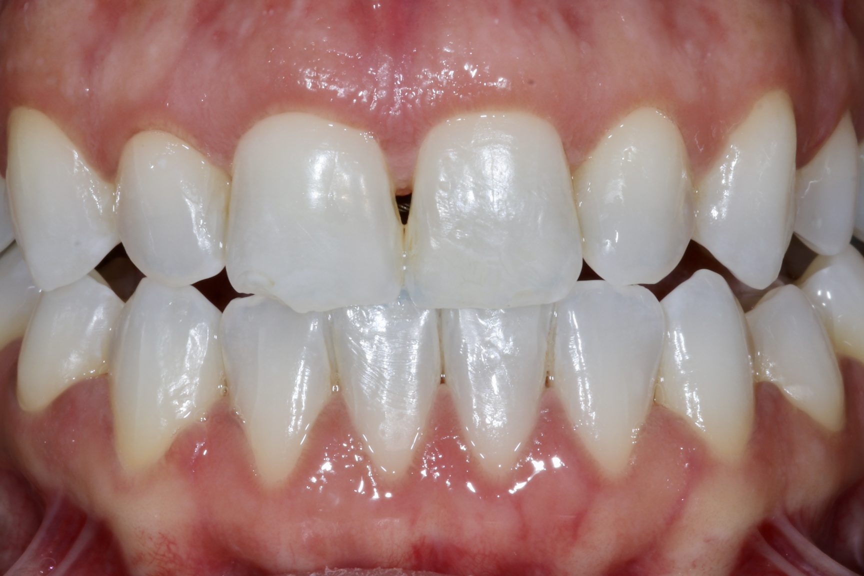 Fig 13 Nishan Dixit describes a minimally invasive alignment, bleaching and edge-bonding case in which the patient was ‘elated and confident’ after their smile transformation.