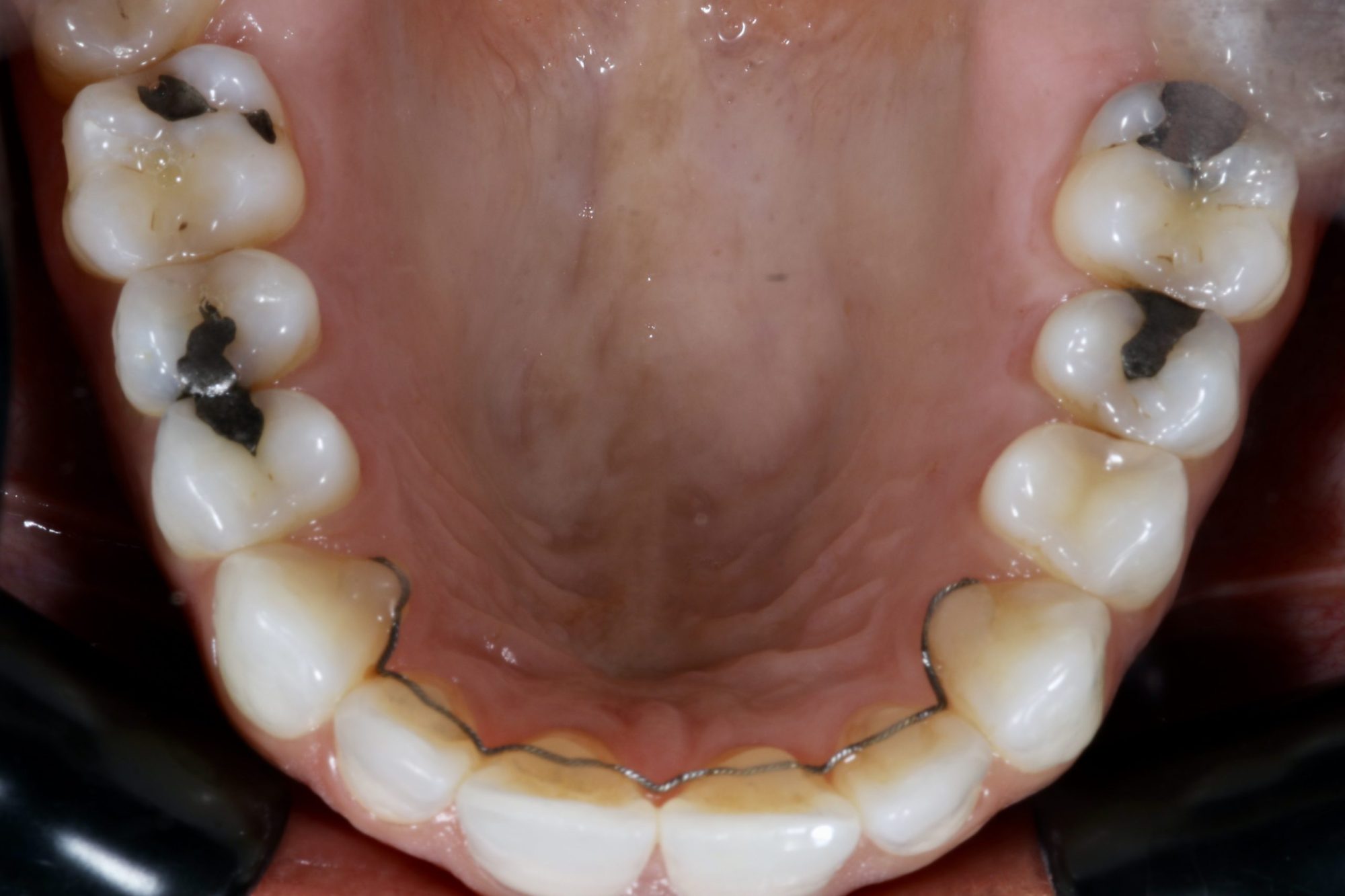 Fig 14 Nishan Dixit describes a minimally invasive alignment, bleaching and edge-bonding case in which the patient was ‘elated and confident’ after their smile transformation.
