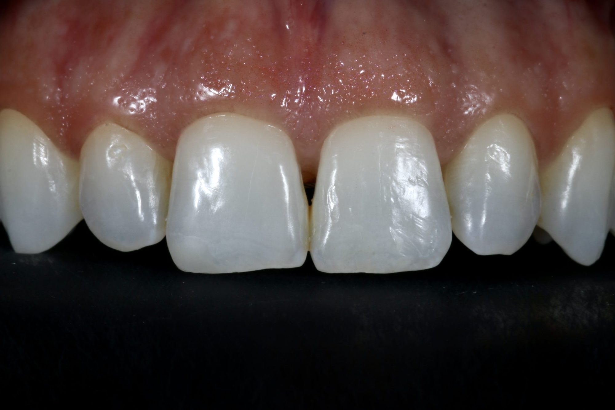 Fig 15 Nishan Dixit describes a minimally invasive alignment, bleaching and edge-bonding case in which the patient was ‘elated and confident’ after their smile transformation.