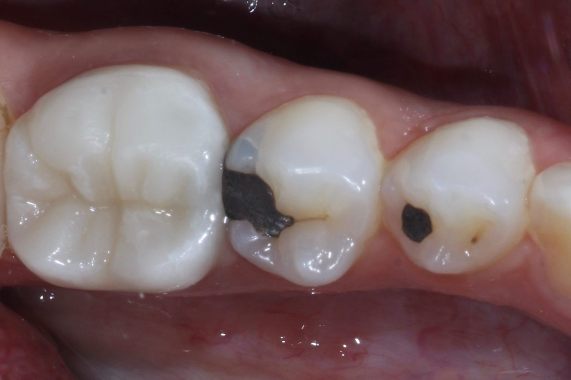Fig 16 Nishan Dixit describes a minimally invasive alignment, bleaching and edge-bonding case in which the patient was ‘elated and confident’ after their smile transformation.