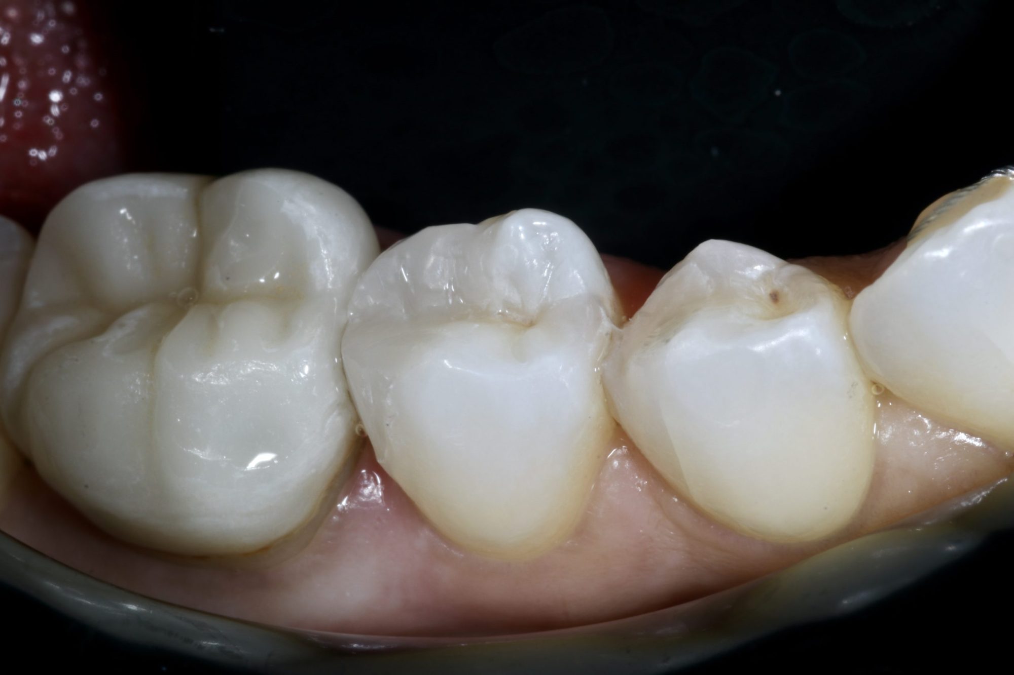 Fig 17 Nishan Dixit describes a minimally invasive alignment, bleaching and edge-bonding case in which the patient was ‘elated and confident’ after their smile transformation.