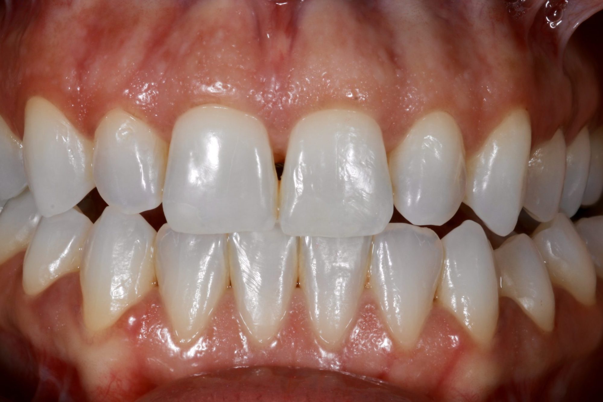 Fig 18 Nishan Dixit describes a minimally invasive alignment, bleaching and edge-bonding case in which the patient was ‘elated and confident’ after their smile transformation.