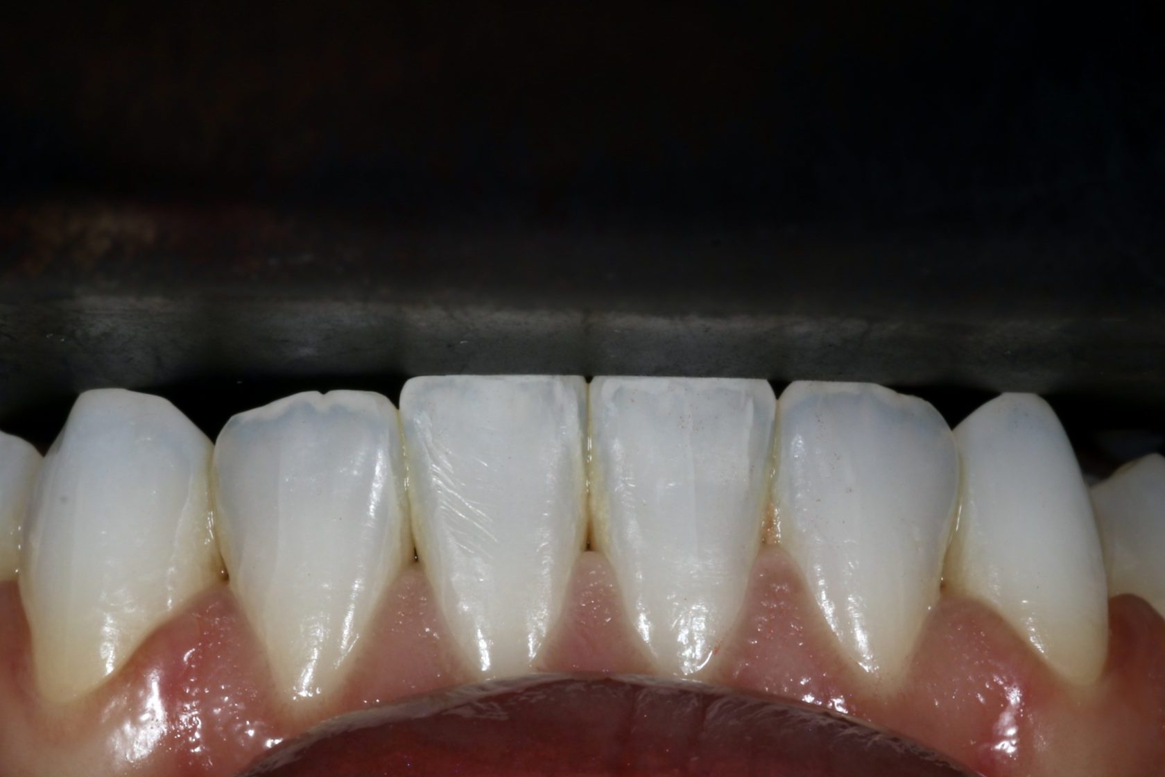 Fig 19 Nishan Dixit describes a minimally invasive alignment, bleaching and edge-bonding case in which the patient was ‘elated and confident’ after their smile transformation.