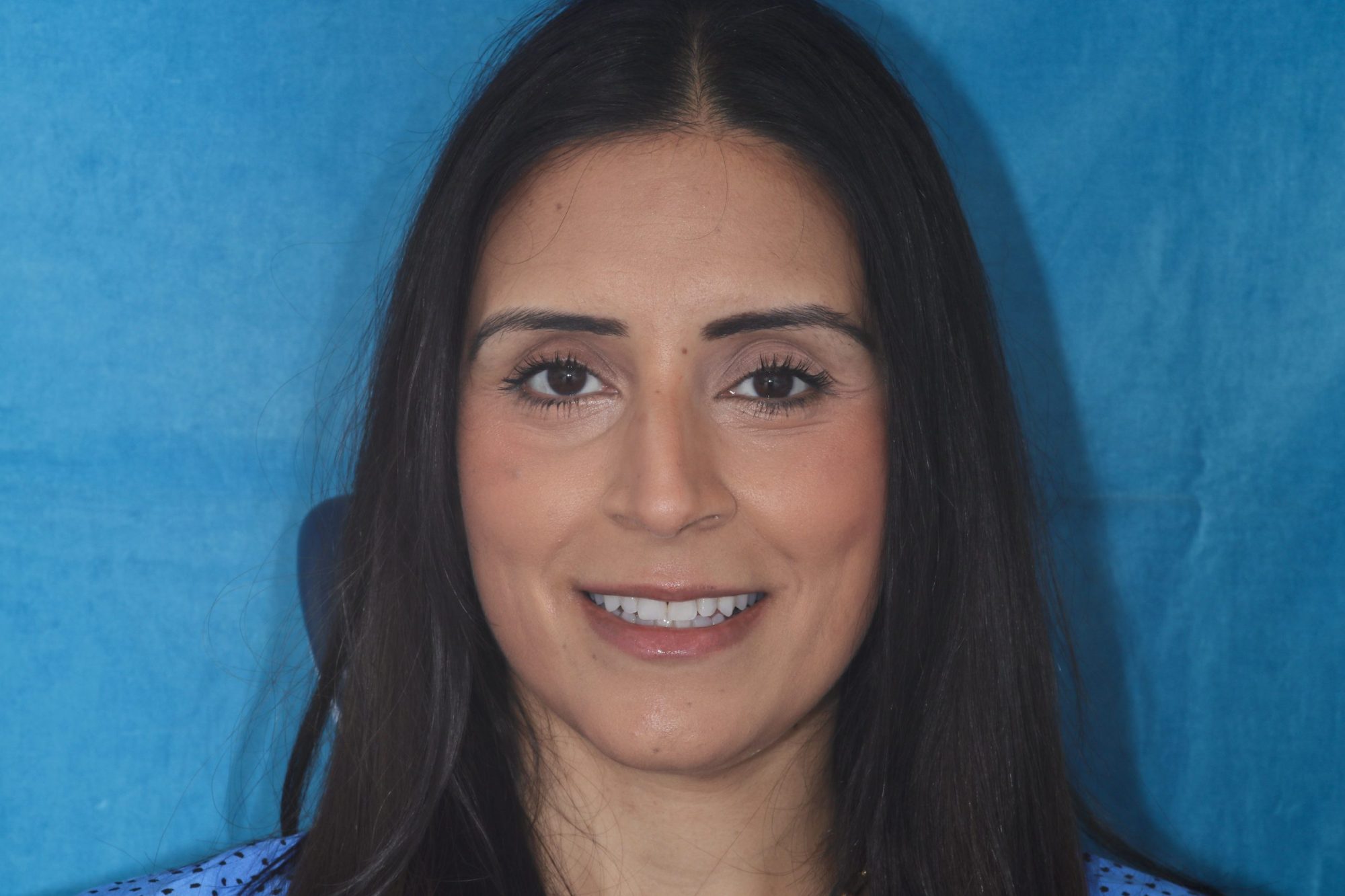 Fig 20 Nishan Dixit describes a minimally invasive alignment, bleaching and edge-bonding case in which the patient was ‘elated and confident’ after their smile transformation.