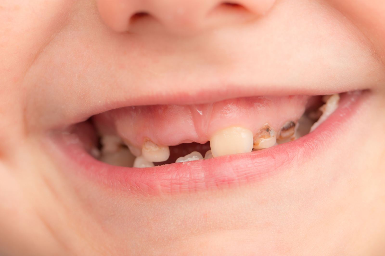 Child tooth decay crisis discussed by MPs and Ministers ...