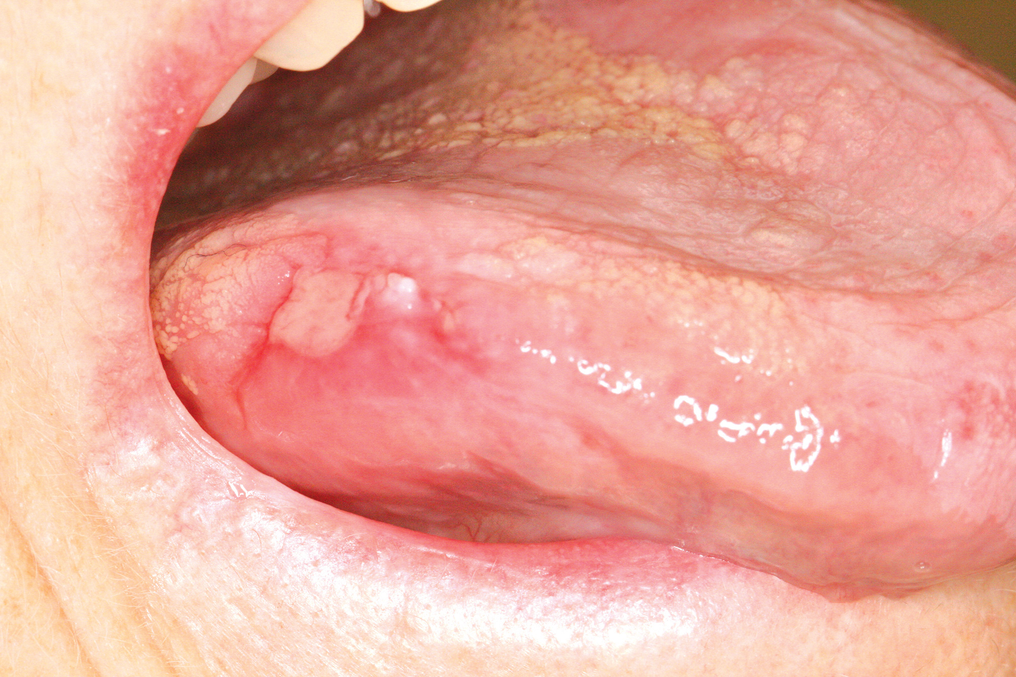 Pictures Of Mouth Cancer