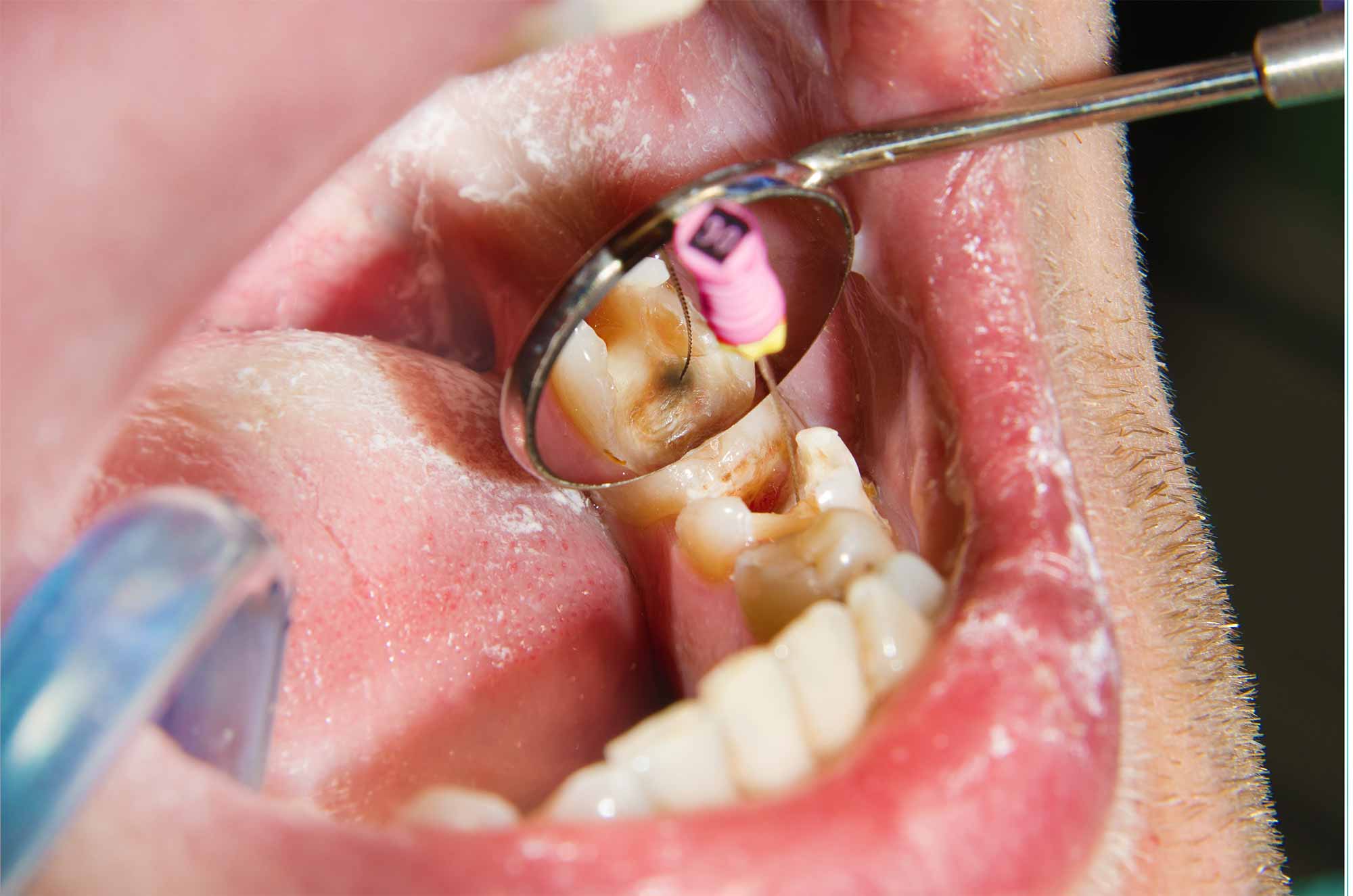 caries in a tooth at dentists