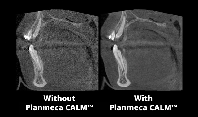 results using Planmeca CALM