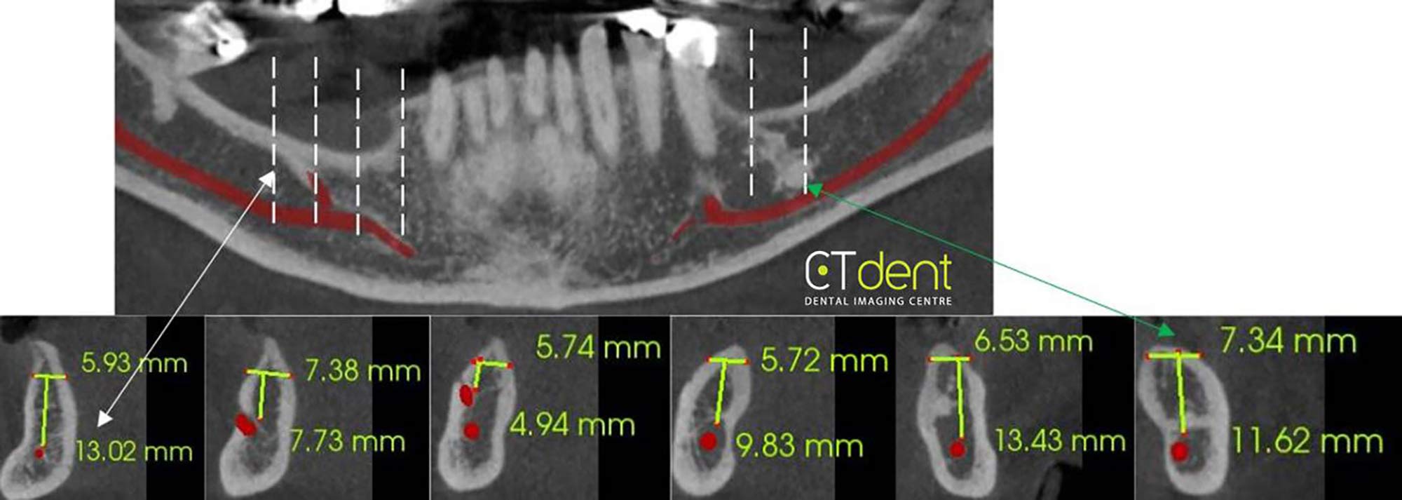 CT Dent scan showing cross-sections through selected areas of the mandible