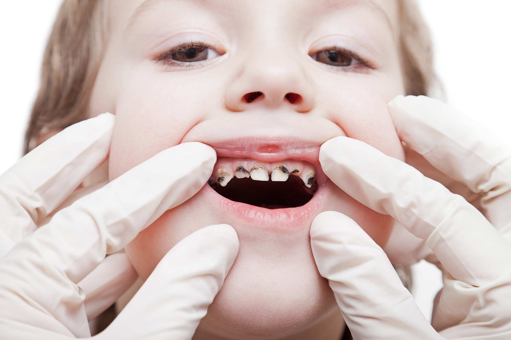 One in four five year olds experience tooth decay, according to new PHE data