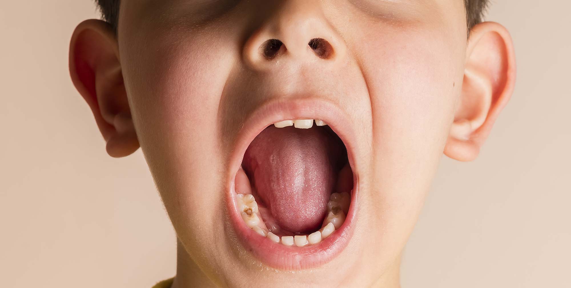 Tooth decay remains the number one reason for hospital admission among five to nine year olds, according to new figures