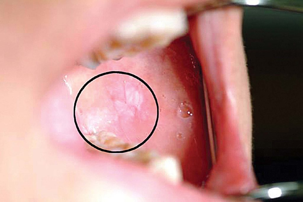 Adjunctive techniques for mouth cancer screening Dentistry Online