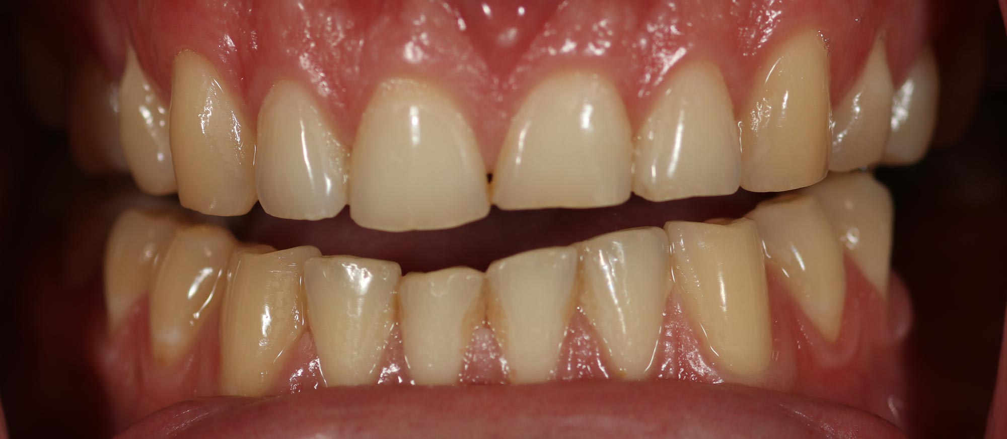 toothwear due to bruxism