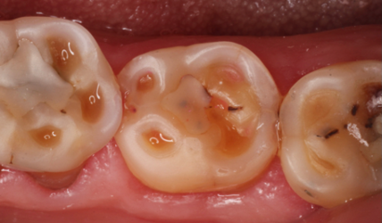 Figure 1 tooth wear
