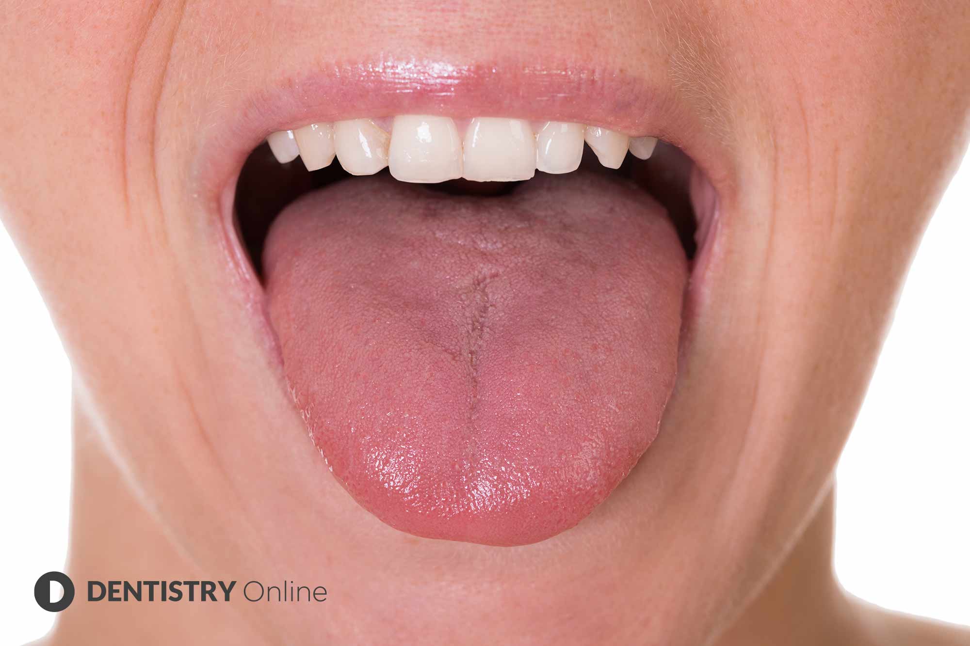 Increasing cases of 'COVID tongue' are being seen in coronavirus positive patients, according to a health expert