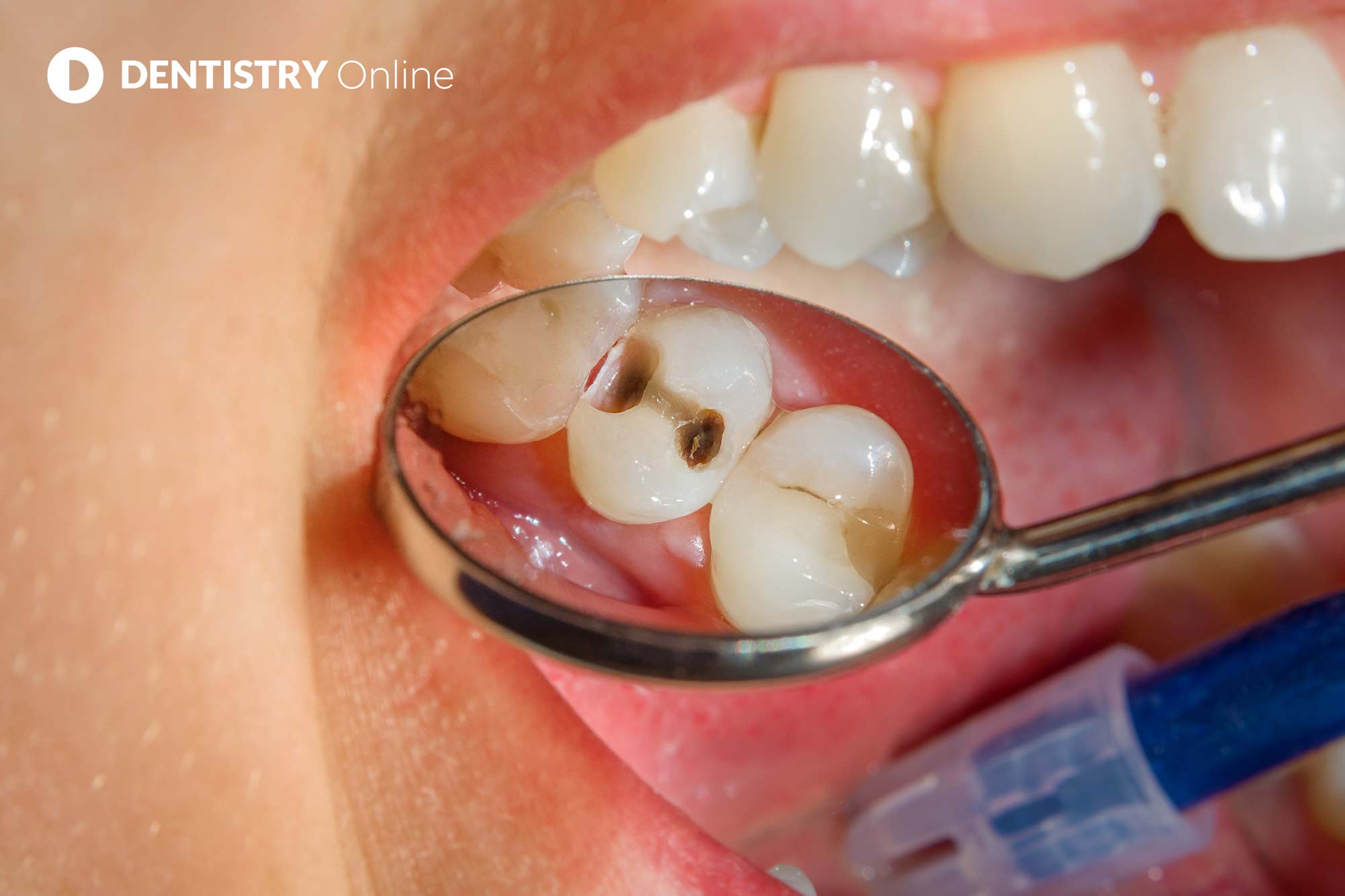 Eight in 10 at increased risk of caries since pandemic, research shows