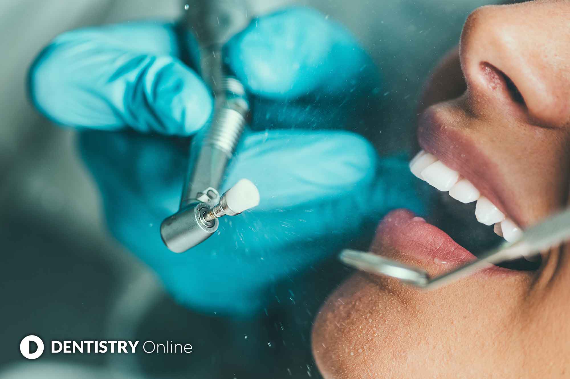 tooth polish procedure